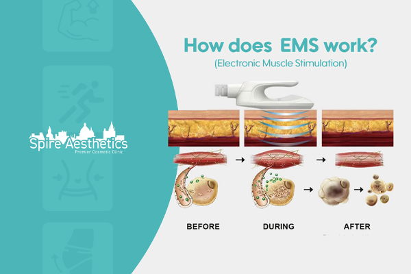 EMS treatment for post pregnancy weight loss treatment Milngavie