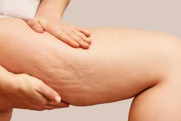 Image of woman showing leg with cellulite Milngavie
