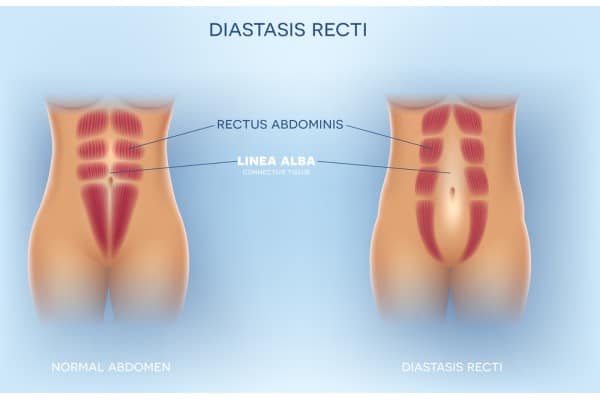 What Non-Surgical Options Are Available for Diastasis Recti Milngavie?
