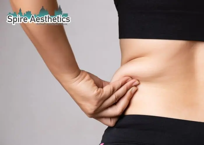 Image of woman pinching fat on their hips Milngavie. Fat Freezing treatment