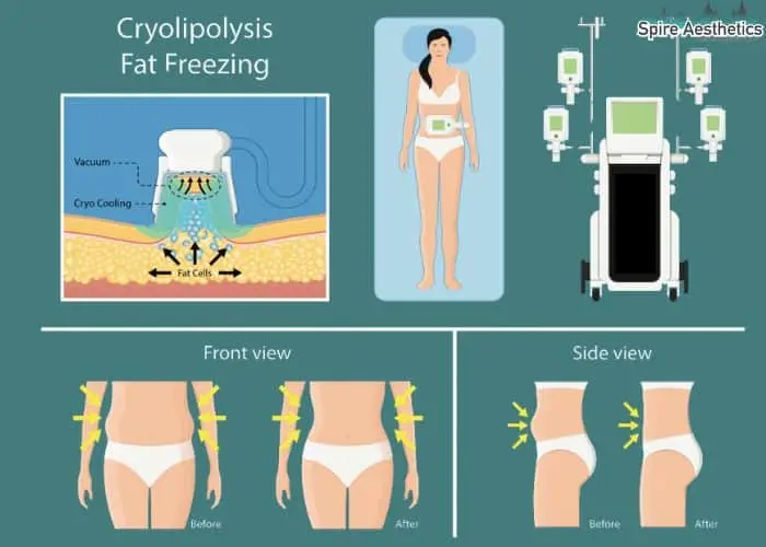 Fat freezing treatment Milngavie benefits for competitions to remove stubborn fat deposits.