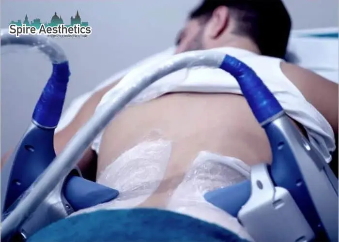 Man having fat freezing treatment done on love handles before a competitions Milngavie to create a sculpted look.