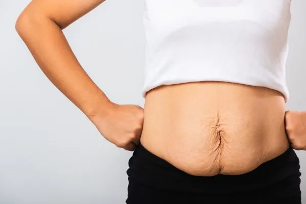 Image of a woman's stomach after weight loss with sagging skin following a gastric band Milngavie