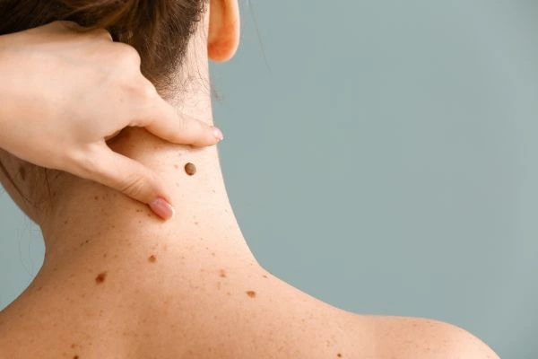 Prices and promotions for blemish removal Milngavie contact our team today!