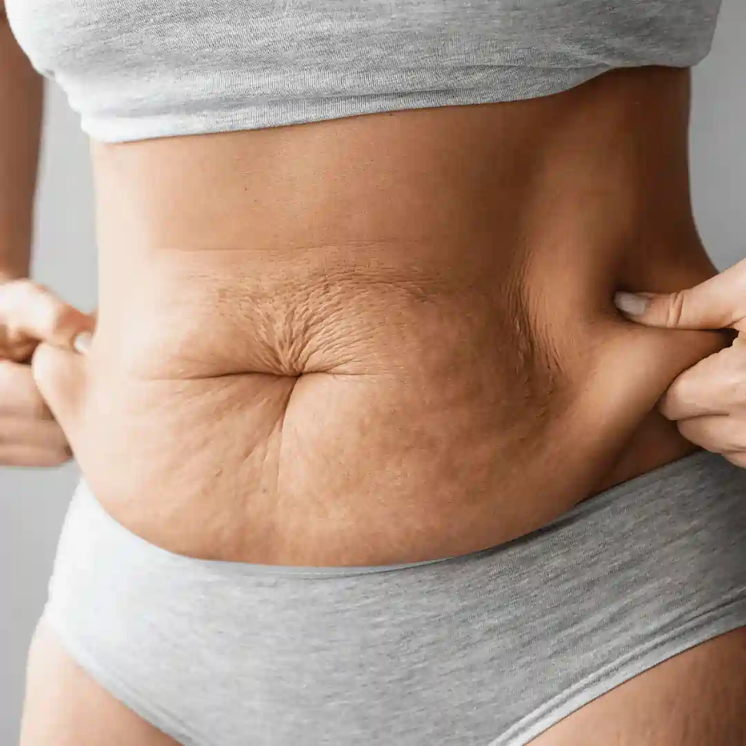 Is It Normal to Have Loose Skin After Pregnancy Milngavie?