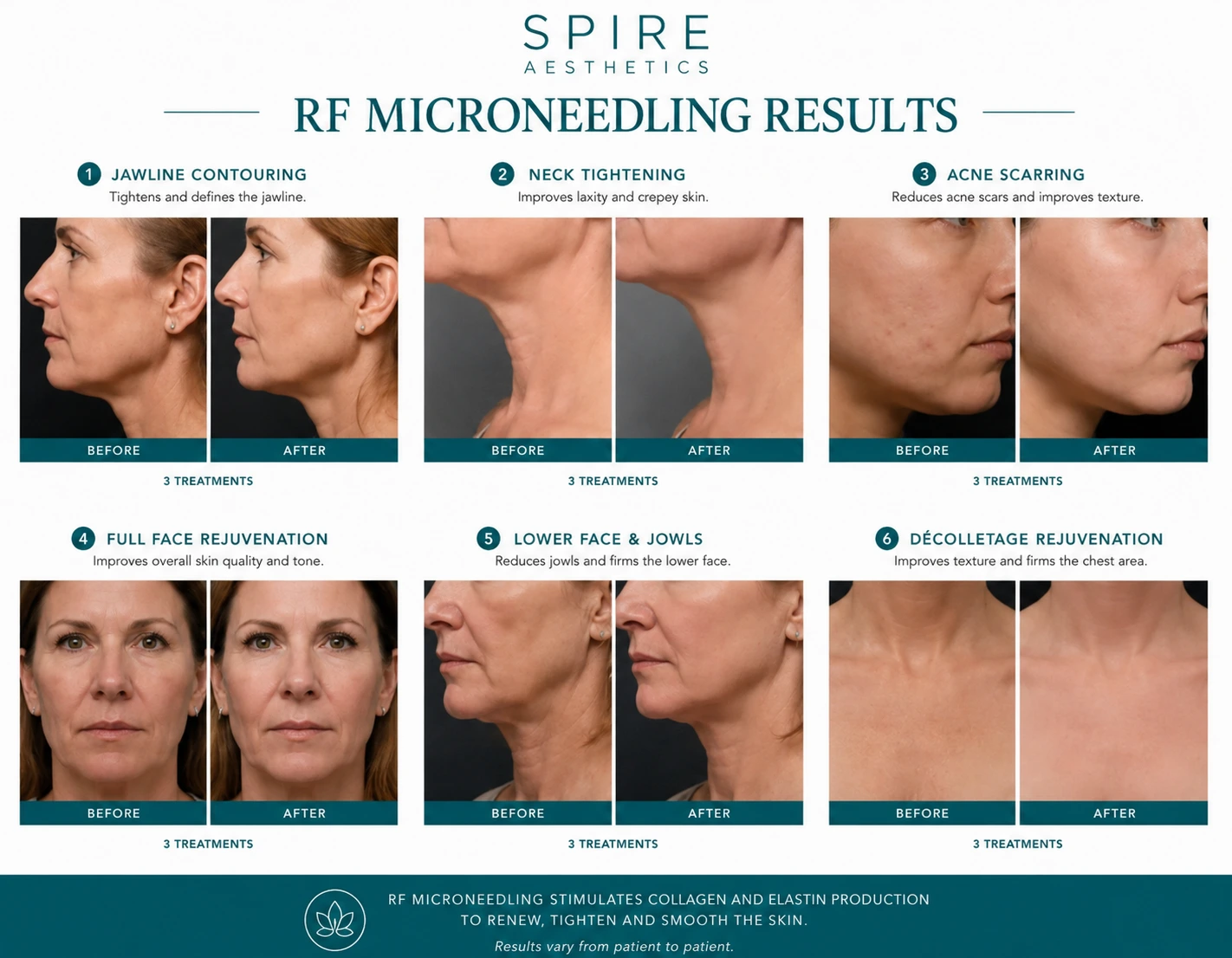 RF Microneedling Skin tightening Milngavie results
