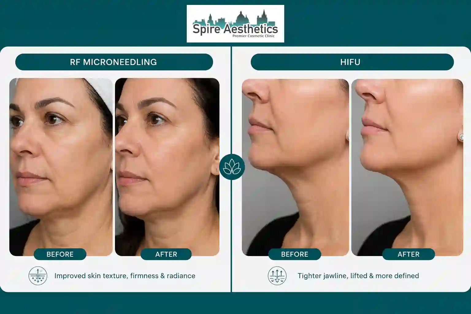 Can RF Microneedling and HIFU Be Combined Milngavie?
