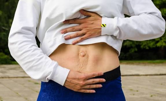 When Could Diastasis Recti Be the Missing Piece of the Puzzle Milngavie?