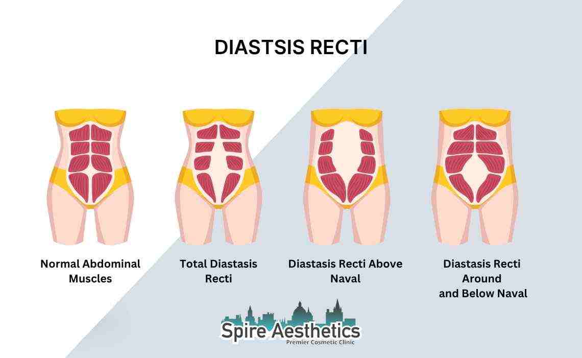 Is Non-Surgical Diastasis Recti Treatment Right for You? Common Concerns Answered Milngavie